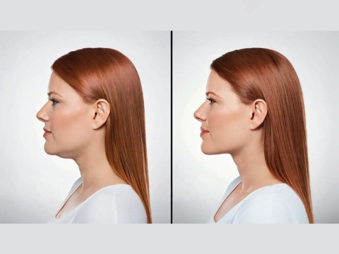 Mesotherapy brfore after