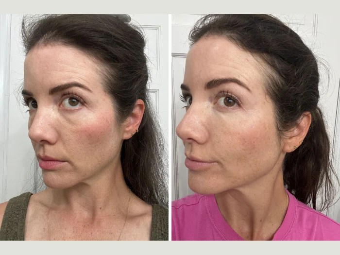 PRP treatment in dubai