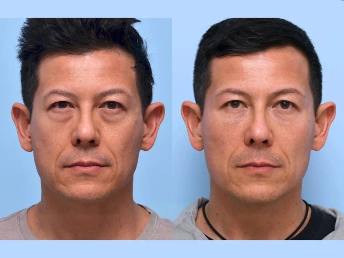 Male fillers