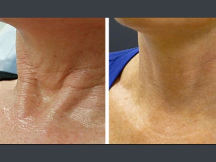prp for neck in uae