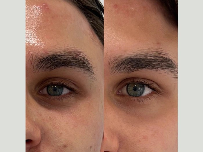 PRP treatment before after