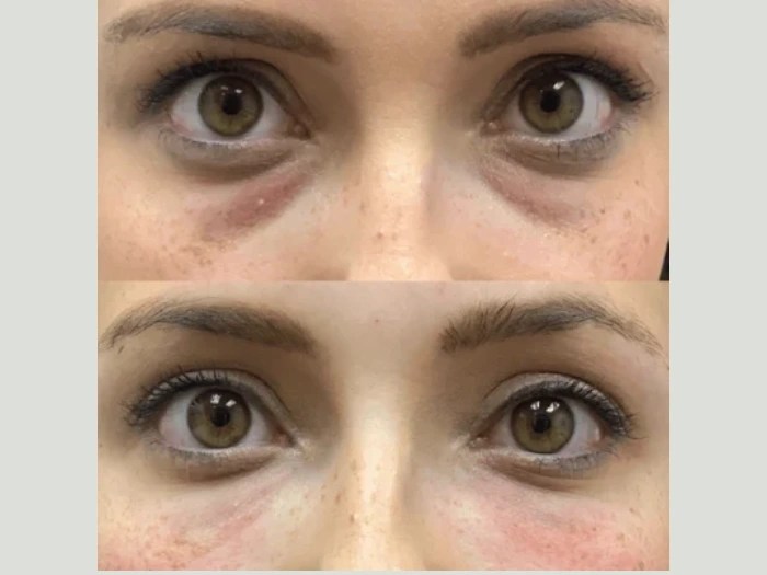 PRP treatment results in dubai