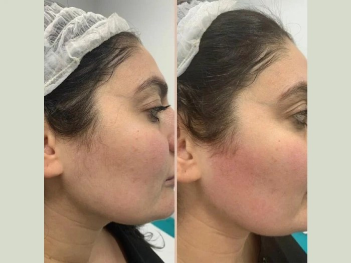 Laser hair removal by candela gentlemax pro in abu dhabi