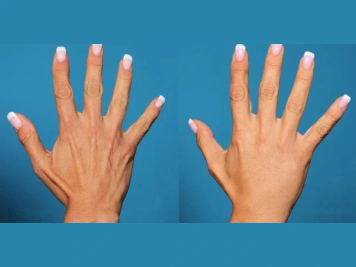 PRP treatment before after