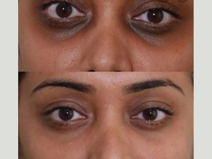 PRP treatment in abu dhabi
