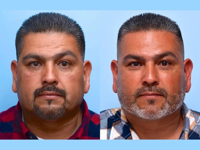 Male fillers
