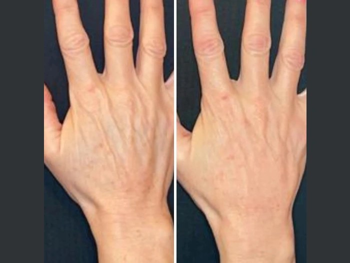 PRP treatment before after pictures