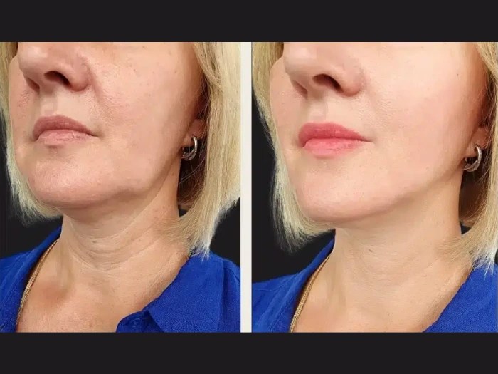 prp for neck in dubai