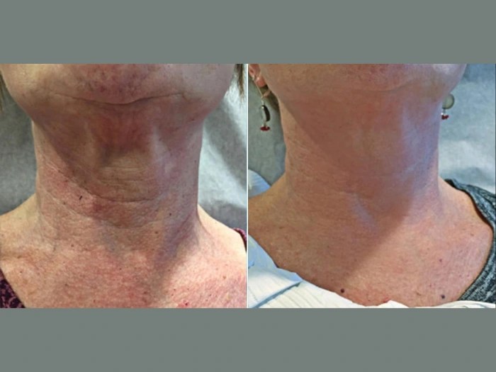 prp for neck in abu dhabi
