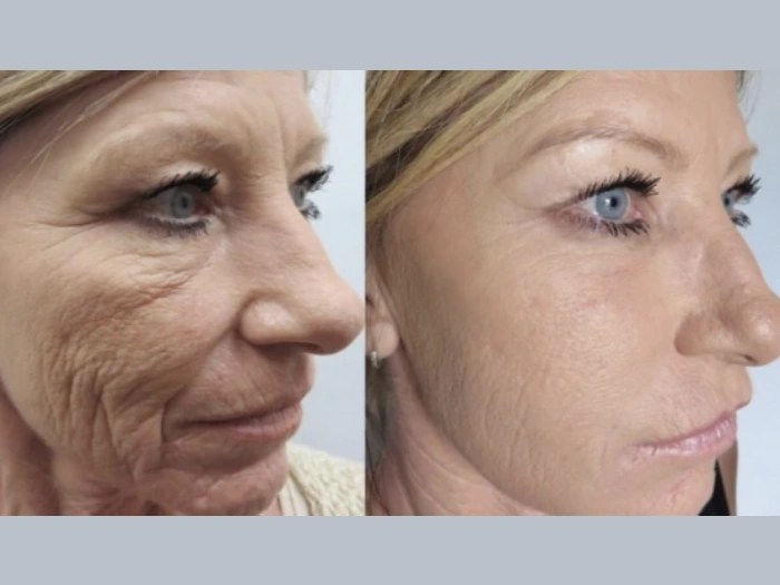 PRP treatment in UAE