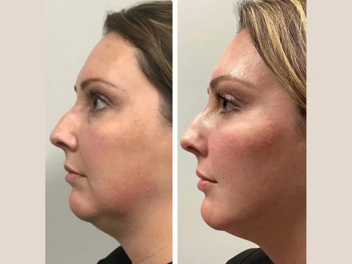 PRP treatment in abu dhabi