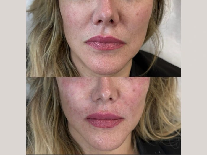 prp treatment before after