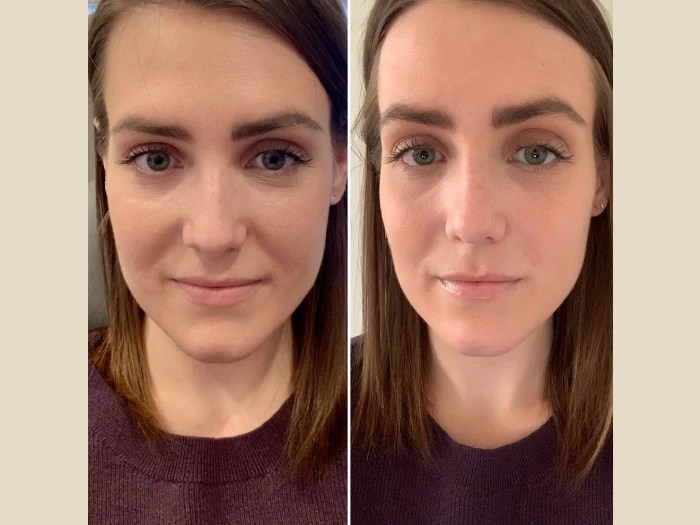 PRP treatment before after pictures