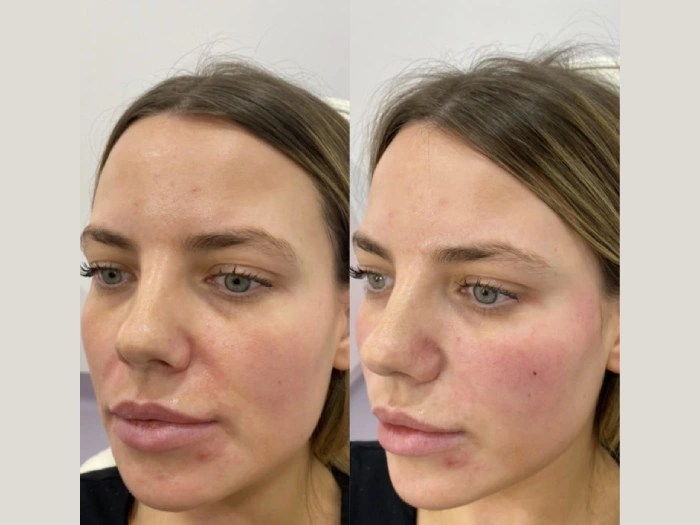 prp treatment before after at perfect drs