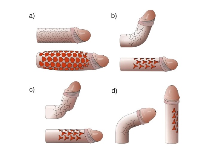 Penoplasty before after uae