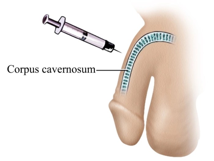 Erectile Dysfunction Treatment before after in dubai