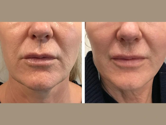 PRP treatment results in dubai
