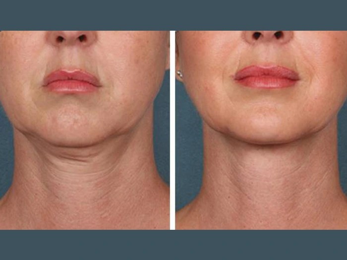 PRP treatment before after pictures