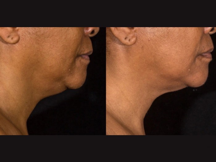 PRP treatment before after abu dhabi