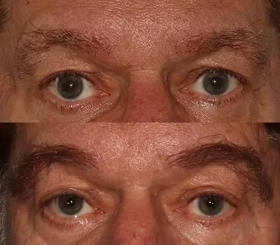 Eyebrow transplant before after result in uae