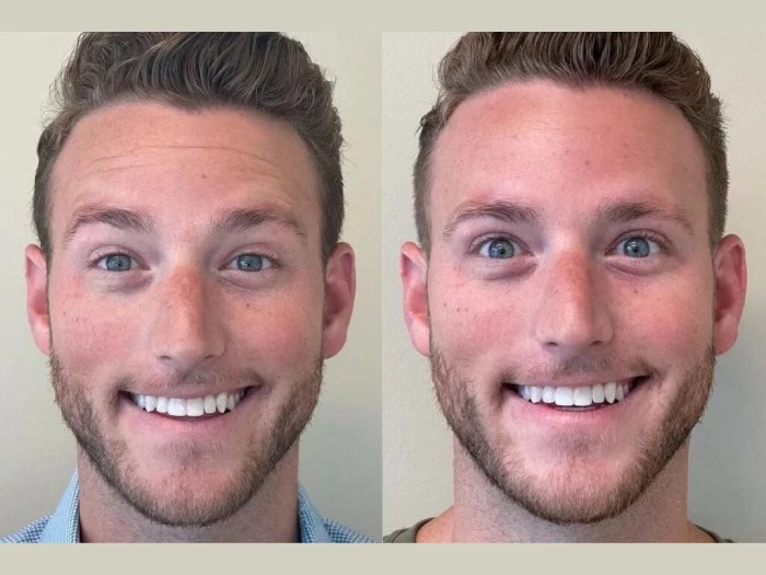male thread lift before after in uae