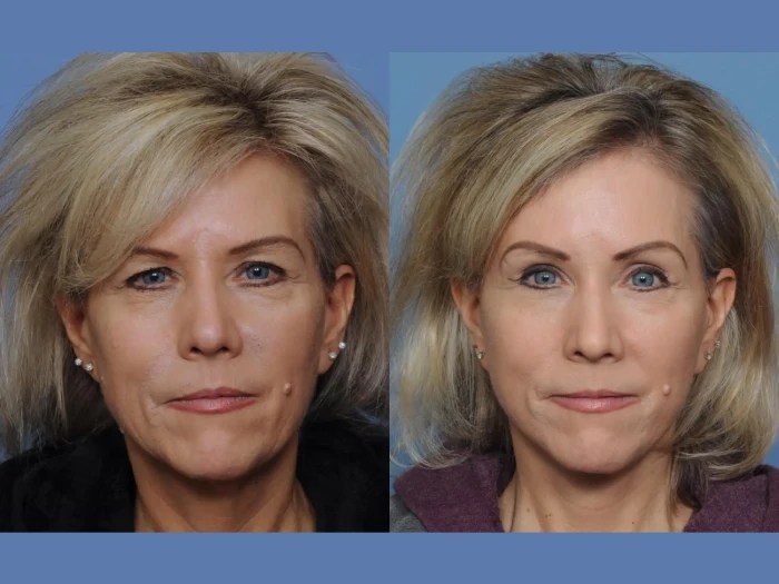 Plexr treatment in dubai