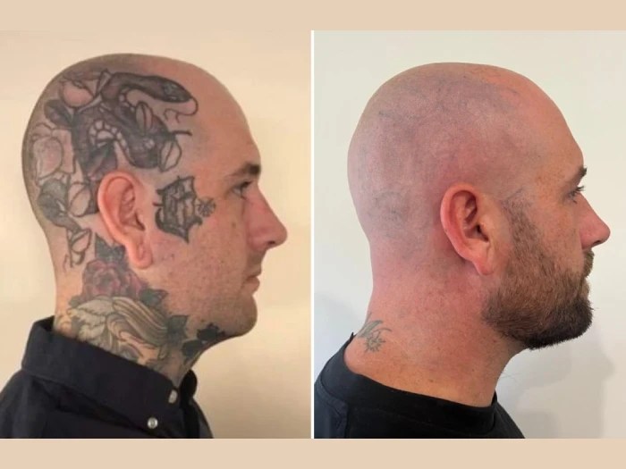 Plexr treatment