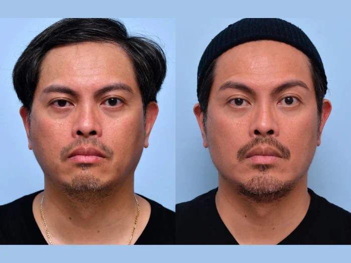 male thread lift in abu dhbai