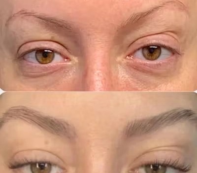 Eyebrow transplant in abu dhabi