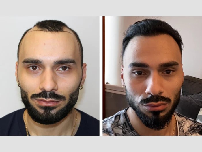 Front line hair fixing before after