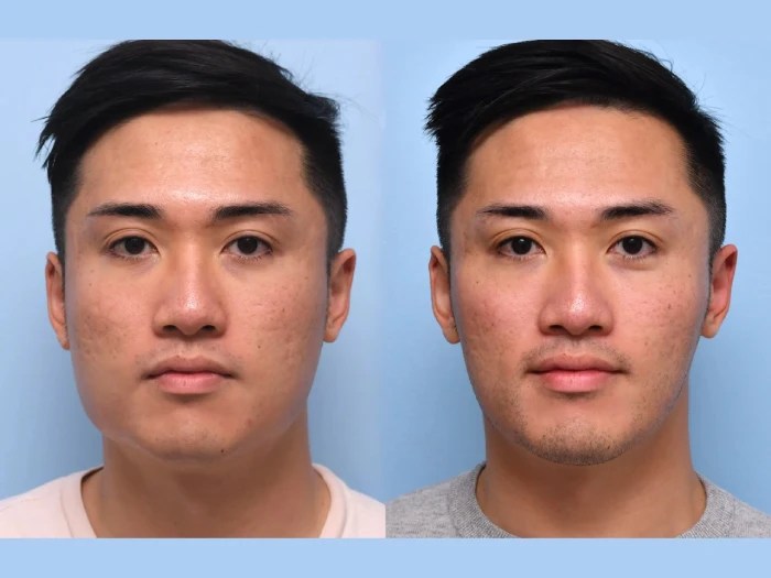 male thread lift in uae
