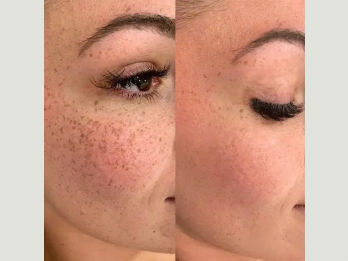 melasma treatment before after in uae