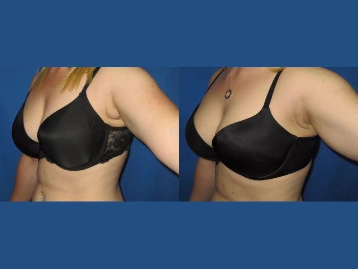 Axillary liposuction uae before after