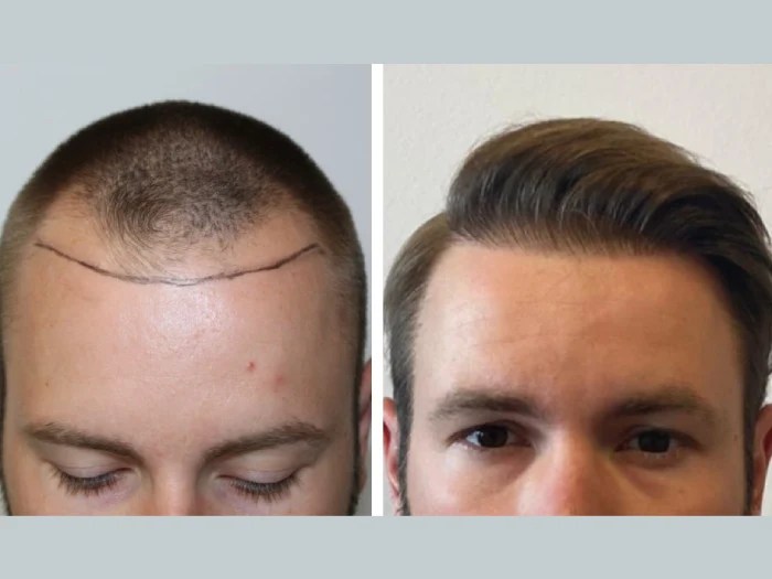 Front line hair fixing before after result in dubai