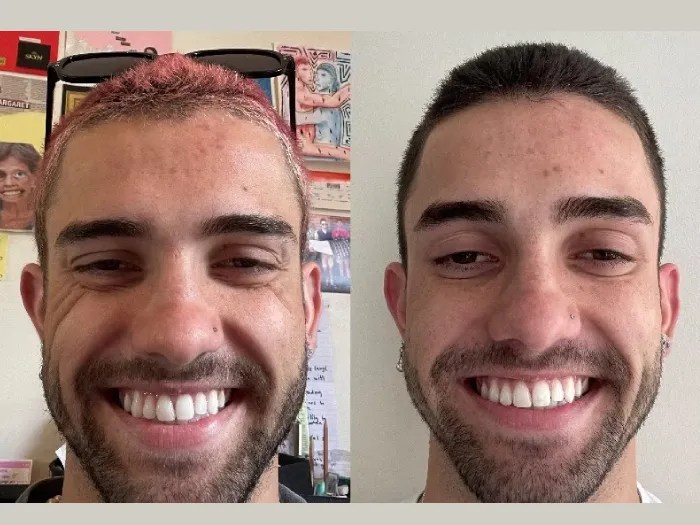 male thread lift in dubai