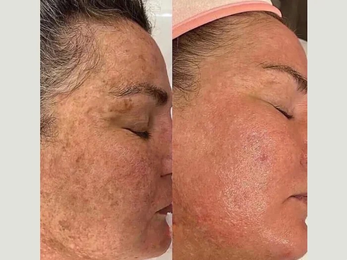 melasma treatment before after in dubai