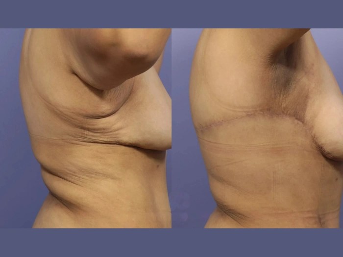 Axillary liposuction abu dhabi before after
