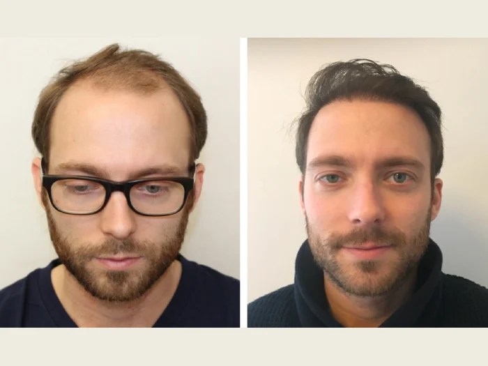 Front line hair fixing before after result in uae