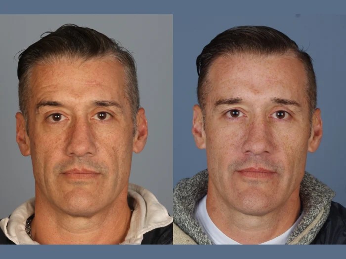 male thread lift before after