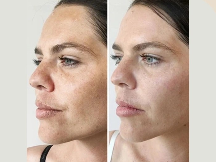 melasma treatment before after result