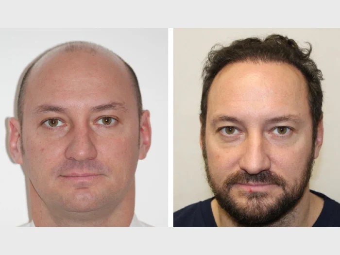 Front line hair fixing before after