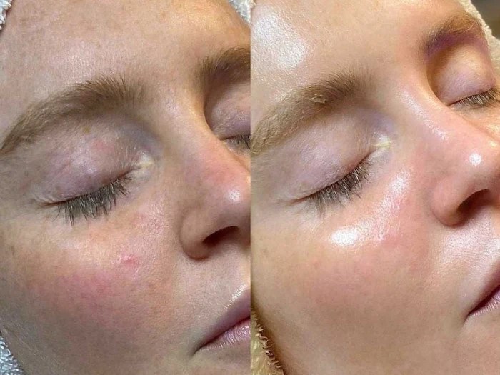 Hydracool Facial In Abu Dhabi