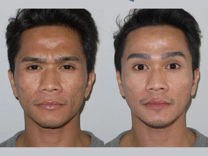 male thread lift before after uae