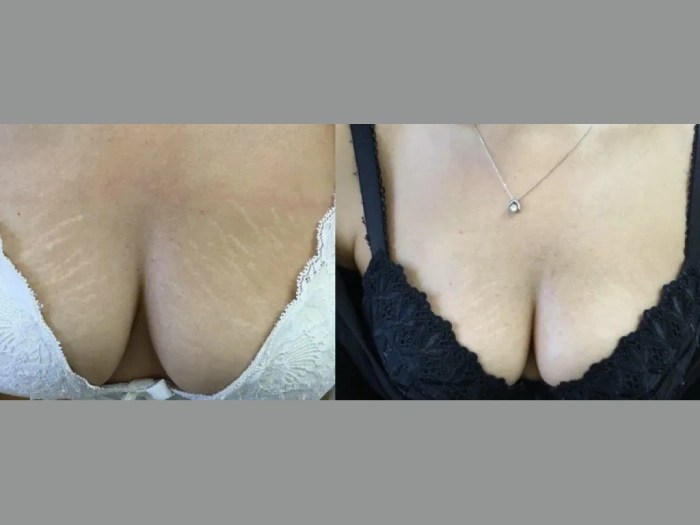Stretch mark treatment in abu dhabi