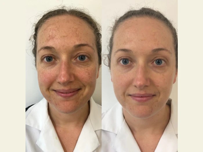 melasma treatment before after