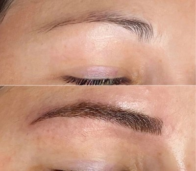 Eyebrow transplant result before after