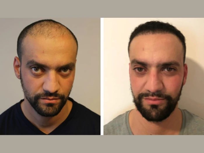 Front line hair fixing dubai before after