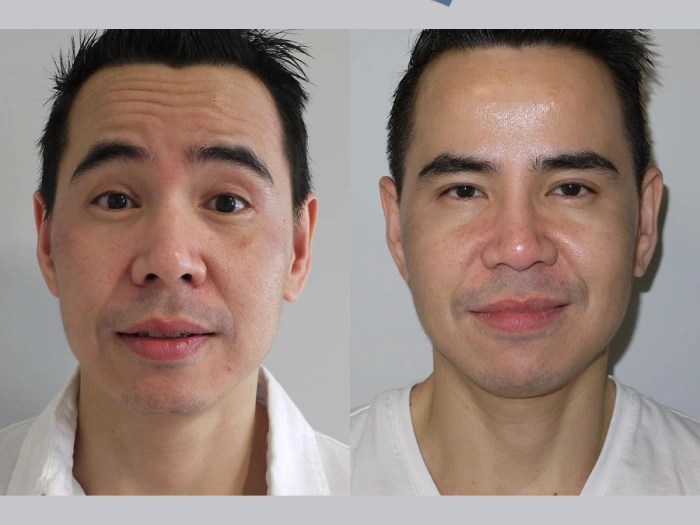 male thread lift before after dubai