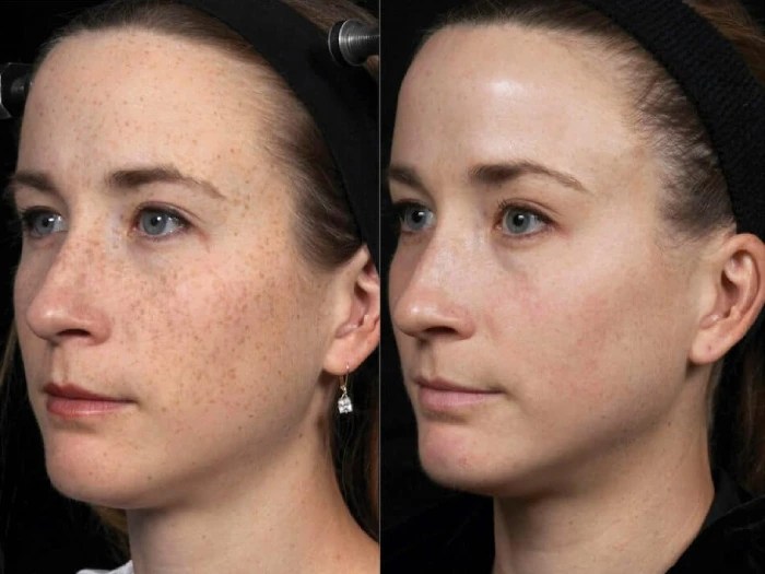 melasma treatment before after results dubai