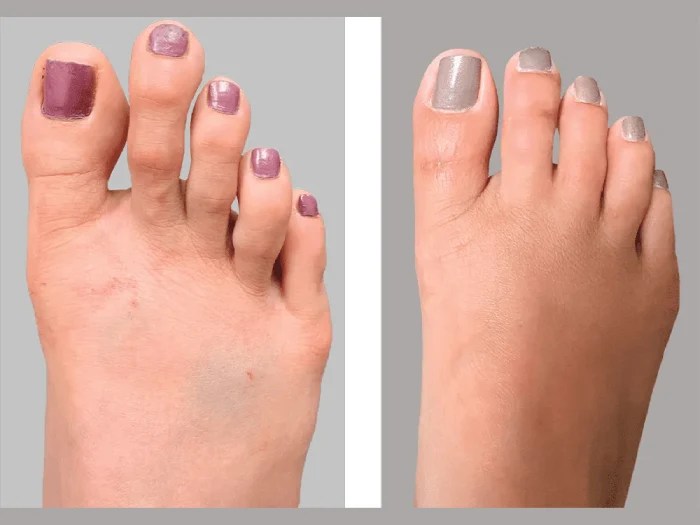 Foot Fillers in Dubai